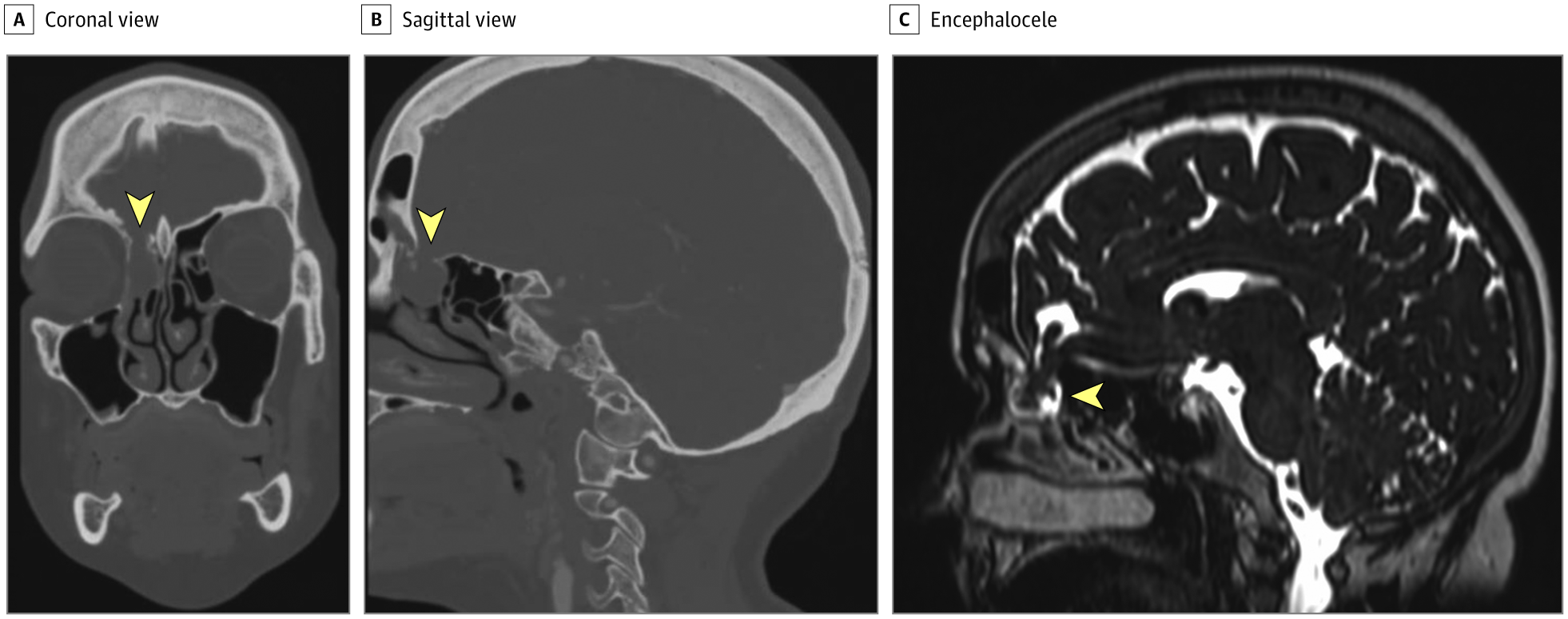 L’encéphalocèle (flèche jaune) est visible au niveau de la fovéa (flèche jaune). © Jama Otolaryngol Head Neck Surg, 2020